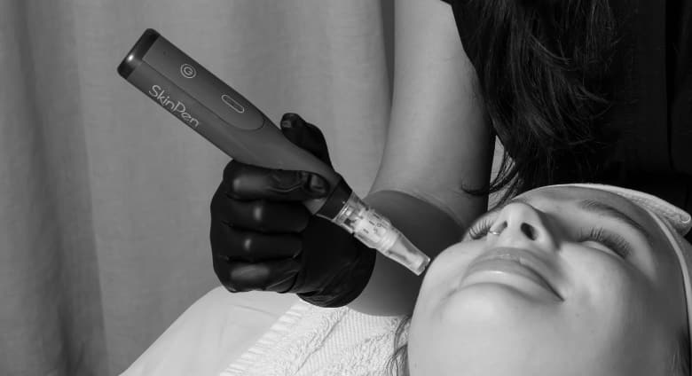A SkinPen microneedling treatment